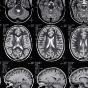 Early Warning Signs of Traumatic Brain Injury After a Car Crash