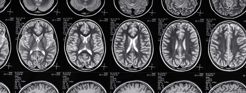 Early Warning Signs of Traumatic Brain Injury After a Car Crash